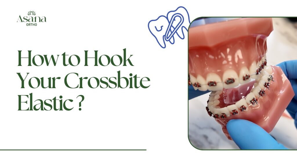 How to Hook Your Crossbite Elastic