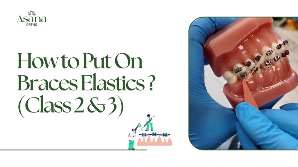 How to Put On Braces Elastics (Class 2 & 3)?