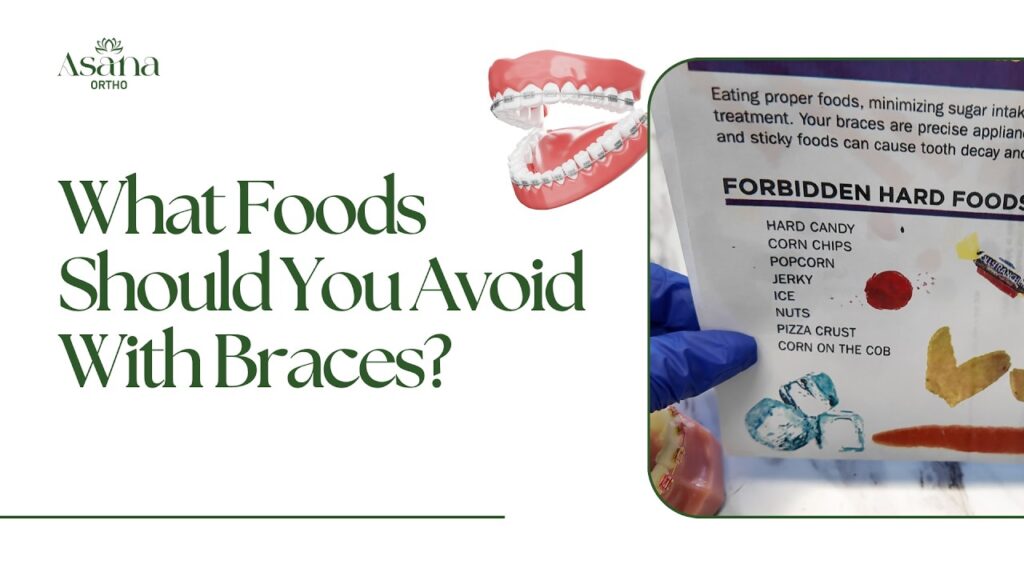 What Foods Should You Avoid With Braces?