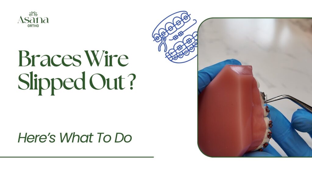 Your Braces Wire Slipped Out? Do this!